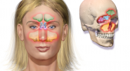 &nbsp; &nbsp; &nbsp; &nbsp; La sinusitis es una inflamación de los senos paranasales, que son los espacios huecos llenos de aire en el cráneo y huesos faciales alrededor de la [&hellip;]
