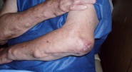 La artritis reumatoidea es una enfermedad crónica que causa inflamación de las articulaciones, tejidos circundantes y puede afectar otros órganos. Es más común en las manos pero en la práctica [&hellip;]