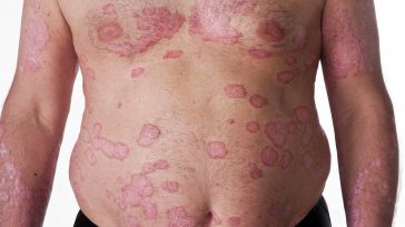 La psoriasis es una enfermedad de la piel causada por la acelerada renovación de las células, este proceso tarda normalmente un mes sin embargo en las personas que sufren este […]