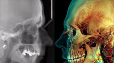 Comparación entre una radiografía clásica y una tomografía  &nbsp; &nbsp; Agencia de Noticias UN «La situación actual es ideal para usar las ayudas tecnológicas disponibles, pues el nuevo coronavirus afecta [&hellip;]