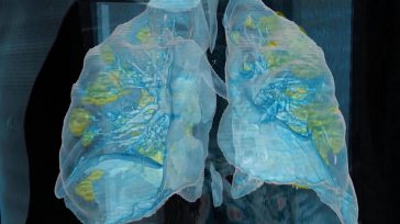 En este modelo 3D basado en una tomografía computarizada vemos que el coronavirus ha causado daños (en amarillo) en los pulmones. Ahora se descubrieron medicamentos que evitan el daño en [&hellip;]