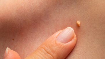 El 80% de las mujeres estarán infectadas de VPH en algún momento de su vida Un estudio ha concluido que los virus del papiloma humano han estado coevolucionando con los [&hellip;]